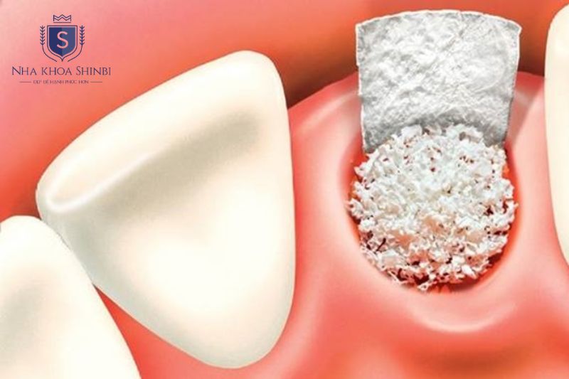 Bác sĩ tiến hành ghép xương và đặt màng collagen