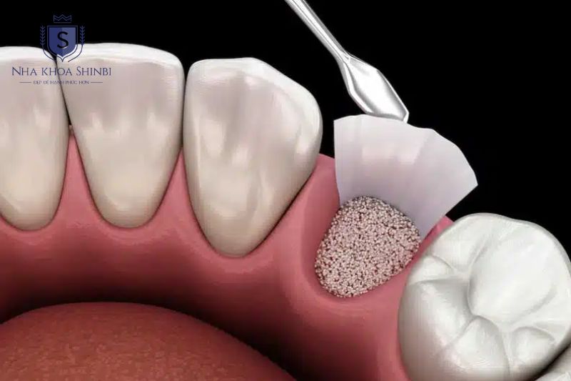 Ghép xương đồng loại sử dụng xương từ người hiến tặng