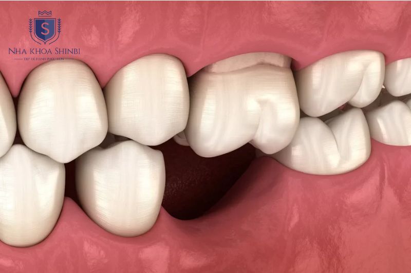 Ghép xương được chỉ định khi mất răng lâu năm gây tiêu xương