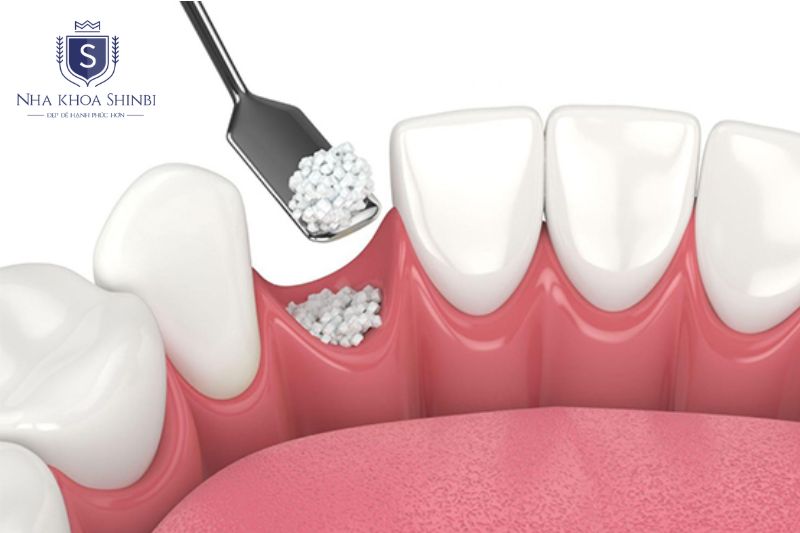 Ghép xương implant là kỹ thuật bổ sung xương vào vị trí xương hàm bị tiêu biến