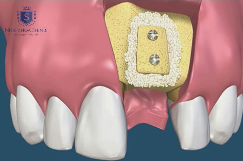 Ghép xương khi cấy implant không gây đau trong suốt quá trình phẫu thuật
