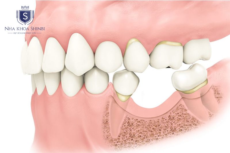 Ghép xương không bắt buộc với tất cả bệnh nhân cấy implant
