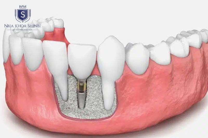 Ghép xương tổng hợp là kỹ thuật phổ biến nhất trong cấy ghép implant
