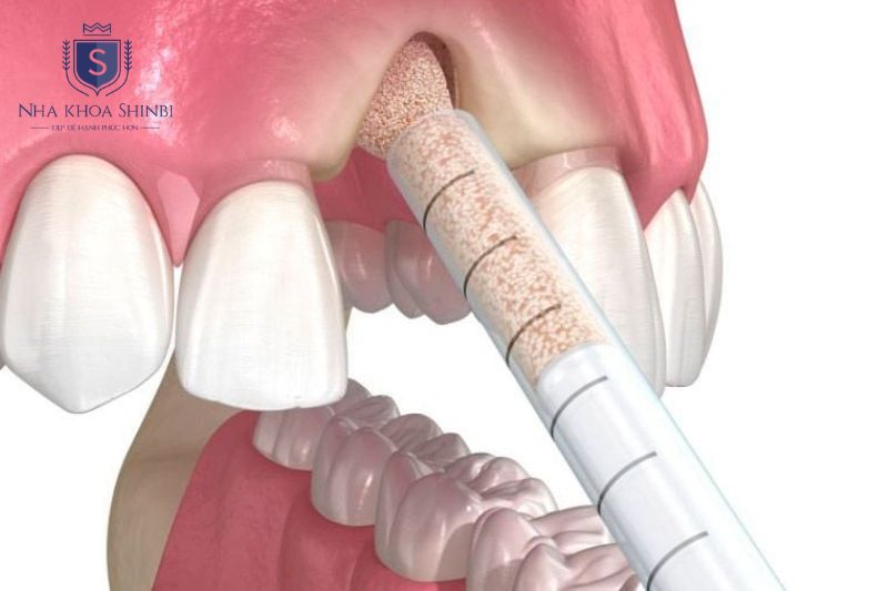 Ghép xương tổng hợp thường có chi phí vật liệu thấp hơn ghép tự thân