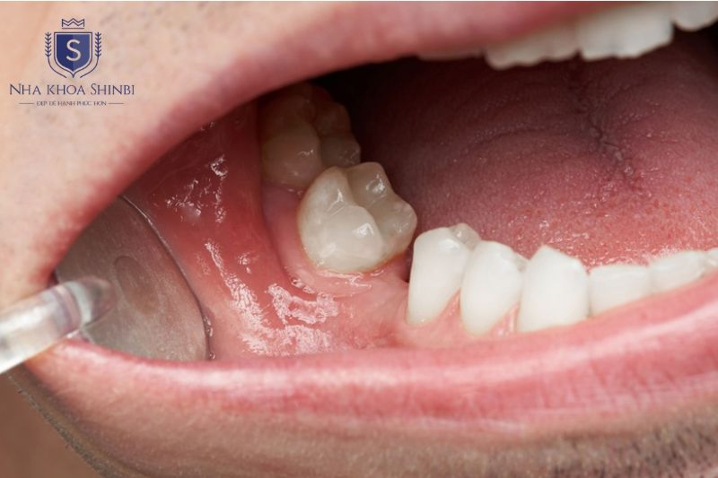Răng xô lệch do mất răng cần chỉnh nha trước khi thực hiện quy trình cấy ghép implant