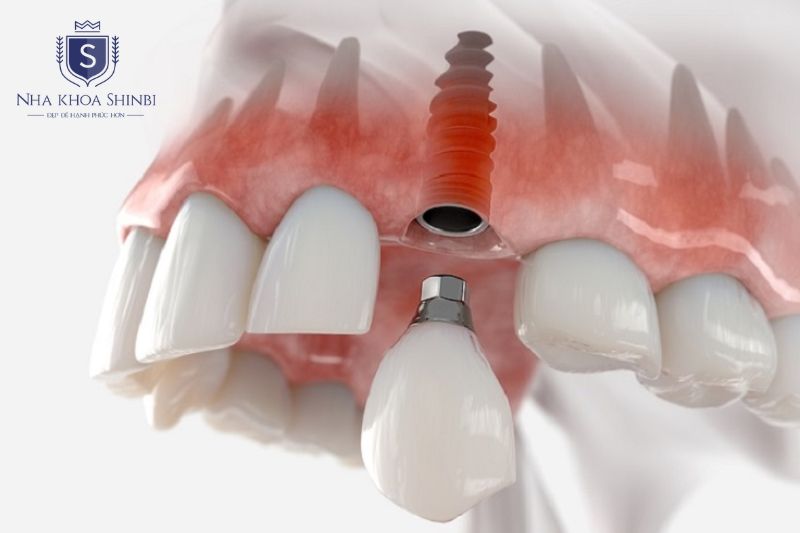 Thời điểm ghép xương phụ thuộc vào mức độ tiêu xương