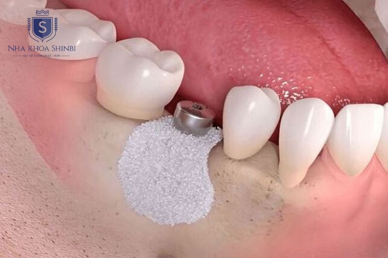 Thời gian lành thương sau ghép xương implant từ 2 đến 6 tháng