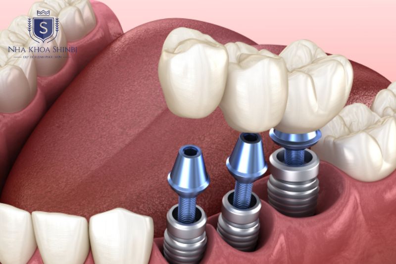Trồng răng implant tại Việt Nam dao động khoảng 26 đến 45.000.000 VNĐ đồng