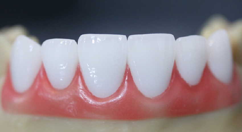 Răng sứ emax là gì? Răng sứ emax là gì?