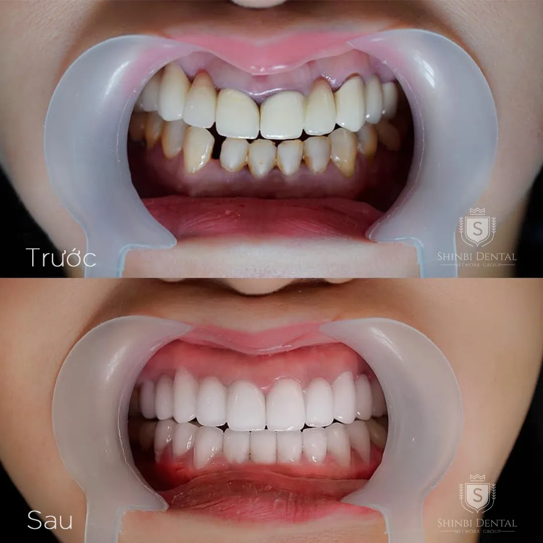 Bọc răng sứ thẩm mỹ – Giải pháp làm đẹp nụ cười đón Tết