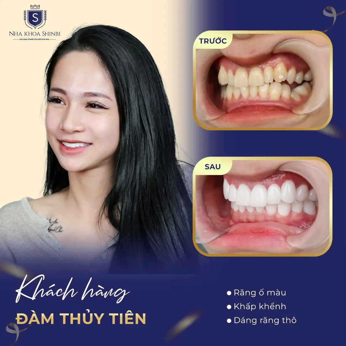 Bọc răng sứ thẩm mỹ – Giải pháp làm đẹp nụ cười đón Tết