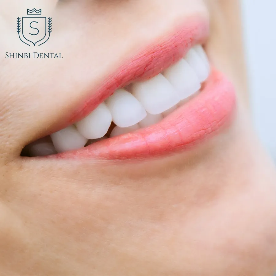 Bọc răng sứ thẩm mỹ – Giải pháp làm đẹp nụ cười đón Tết