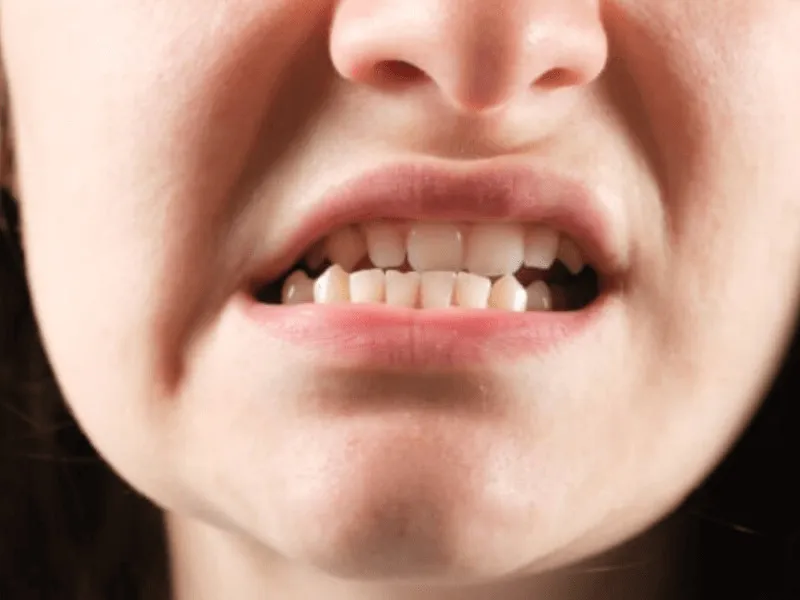 Cắn đồ ăn bị lệch sang một bên cần chỉnh nha ở đâu tại Hà Nội
