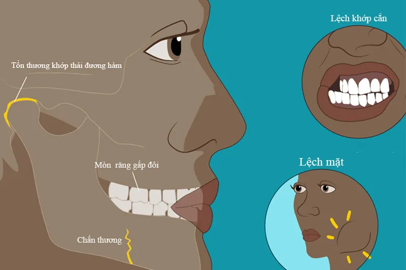 Cắn đồ ăn bị lệch sang một bên cần chỉnh nha ở đâu tại Hà Nội