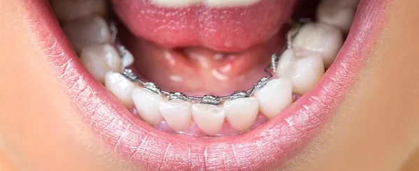 Cắn đồ ăn bị lệch sang một bên cần chỉnh nha ở đâu tại Hà Nội