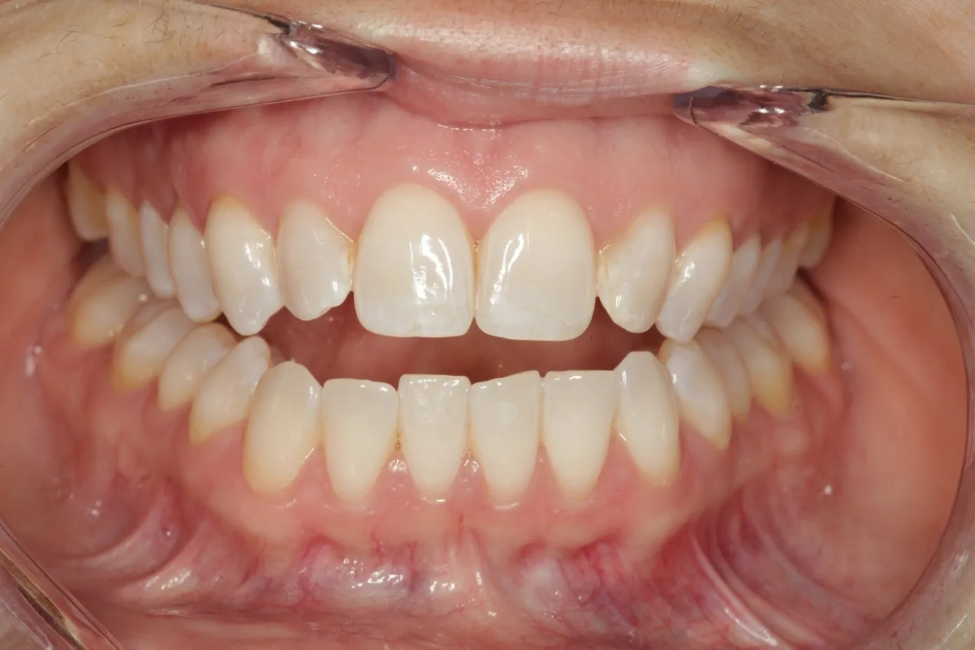 Cắn hở khiến khó cắn thức ăn nên tìm chuyên gia ở đâu tại Hà Nội