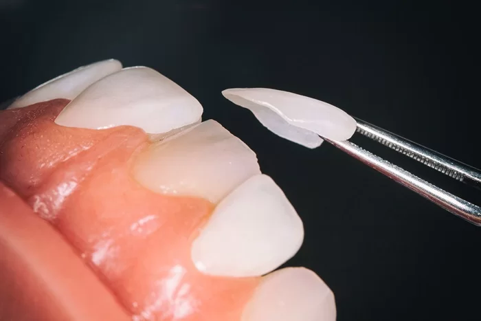 Dán sứ Veneer là gì? Cấu tạo, chỉ định và hiệu quả thẩm mỹ