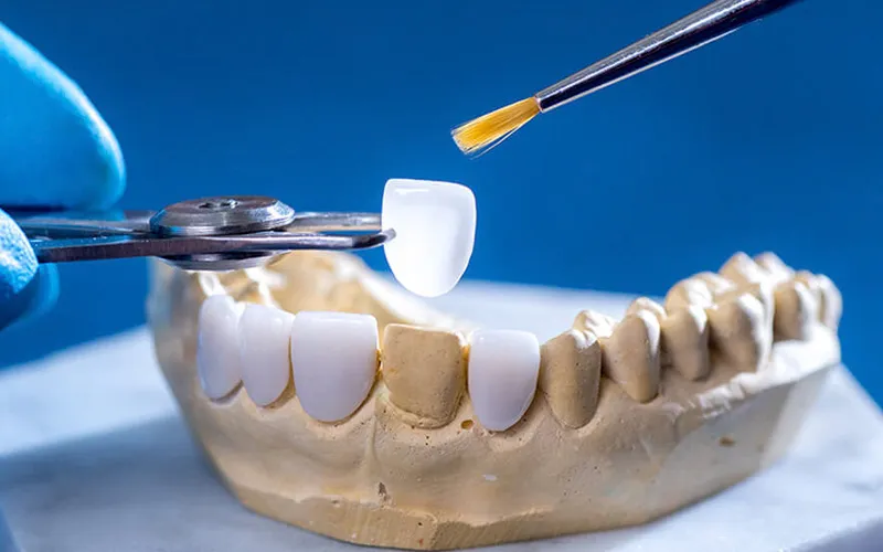 Dán sứ Veneer là gì? Cấu tạo, chỉ định và hiệu quả thẩm mỹ