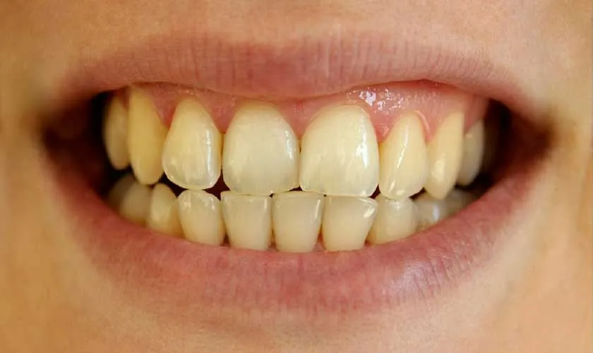 Dán sứ Veneer là gì? Cấu tạo, chỉ định và hiệu quả thẩm mỹ