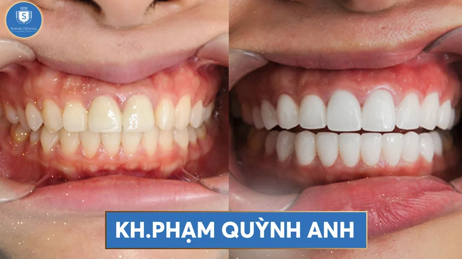 Dán sứ Veneer là gì? Cấu tạo, chỉ định và hiệu quả thẩm mỹ
