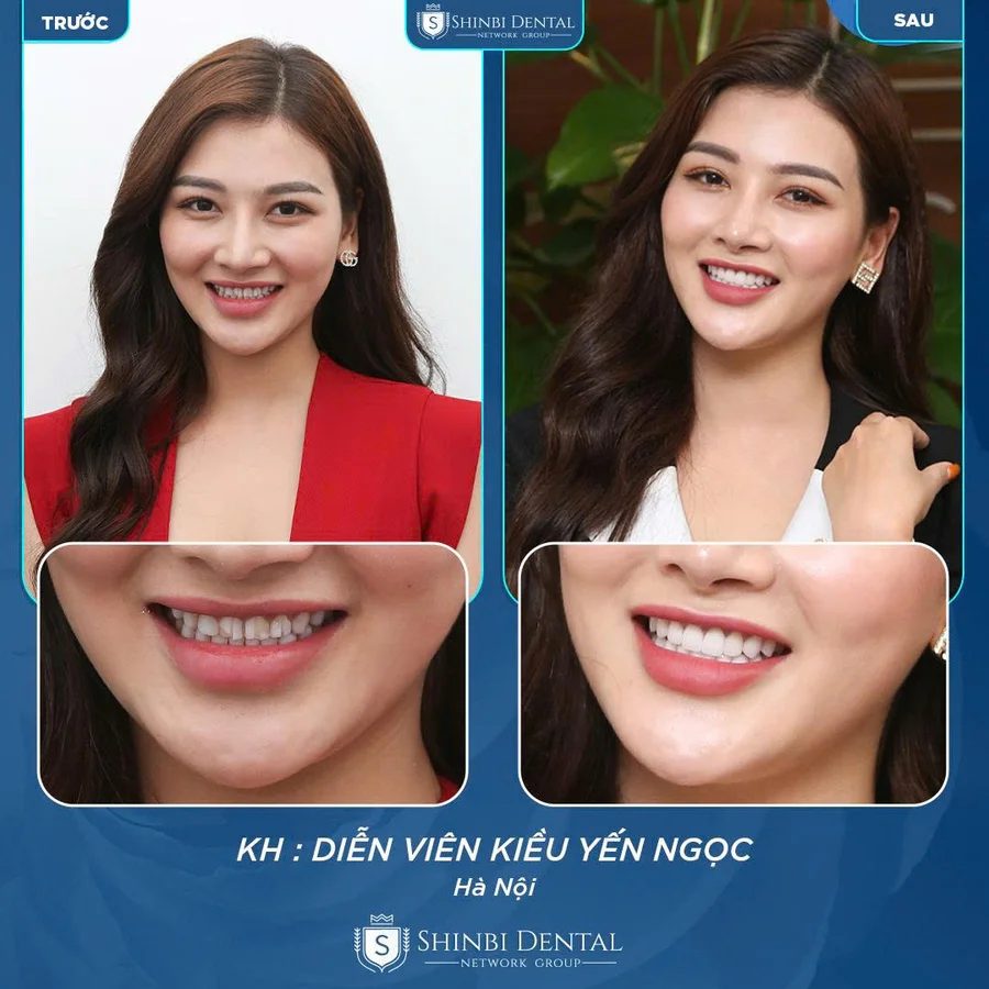 Dán sứ Veneer là gì? Cấu tạo, chỉ định và hiệu quả thẩm mỹ