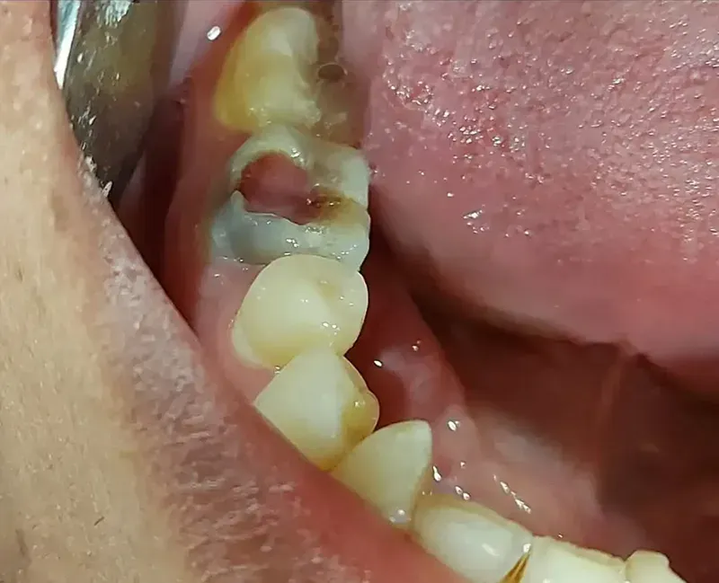 Đau răng, viêm tuỷ sát Tết – Nên xử lý thế nào