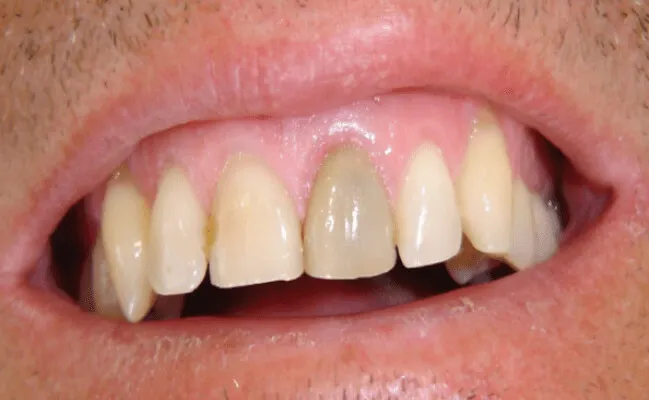 Điều trị tuỷ răng an toàn – Giải quyết đau răng trước Tết