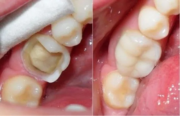Điều trị tuỷ răng an toàn – Giải quyết đau răng trước Tết