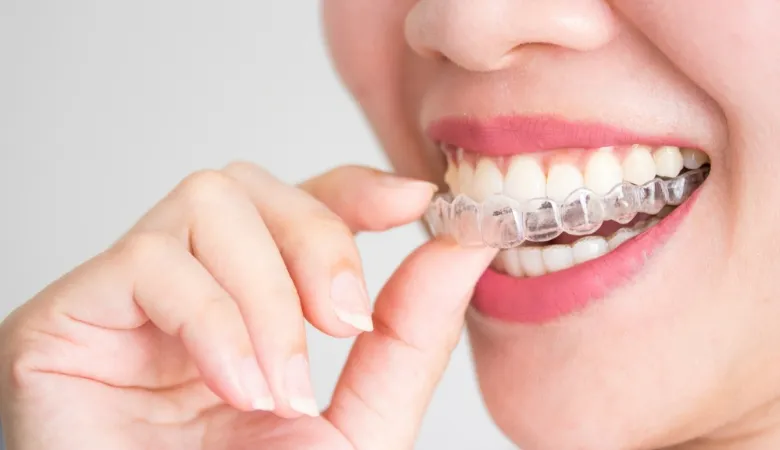 Niềng răng Invisalign tại Trần Quốc Toản: Nha khoa Shinbi Hà Nội