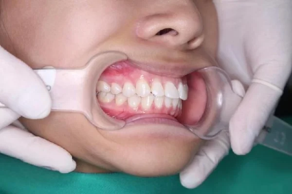 Niềng răng Invisalign tại Trần Quốc Toản: Nha khoa Shinbi Hà Nội