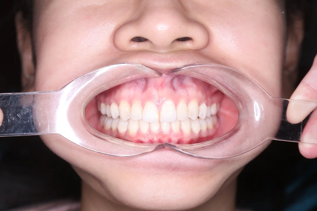 Niềng răng Invisalign tại Trần Quốc Toản: Nha khoa Shinbi Hà Nội