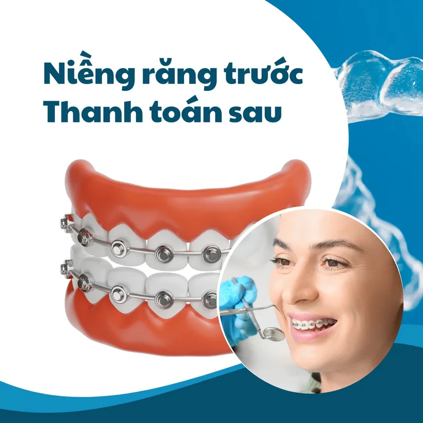 Niềng răng trả góp 0%: điều kiện, thời gian & cách đăng ký