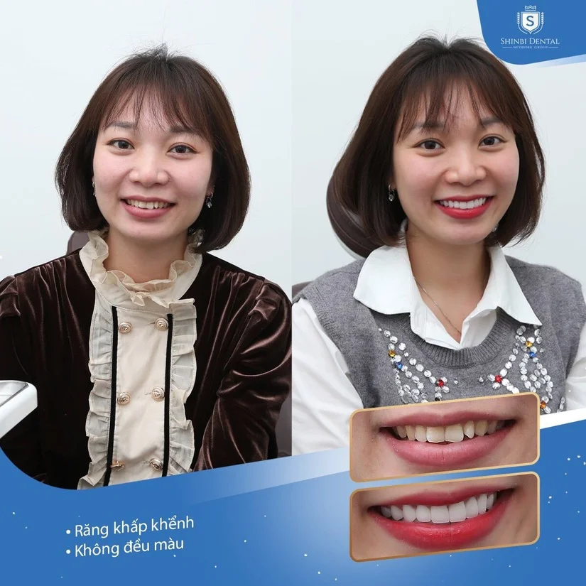Răng sứ DDBio Đức: bảng giá & cảm nhận thực tế