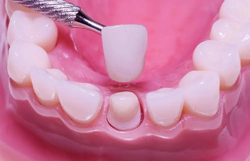 Răng sứ có bền không? Tuổi thọ thực tế bao nhiêu năm?