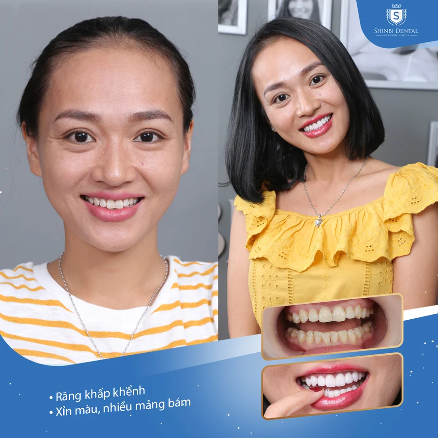 Răng sứ có bền không? Tuổi thọ thực tế bao nhiêu năm?