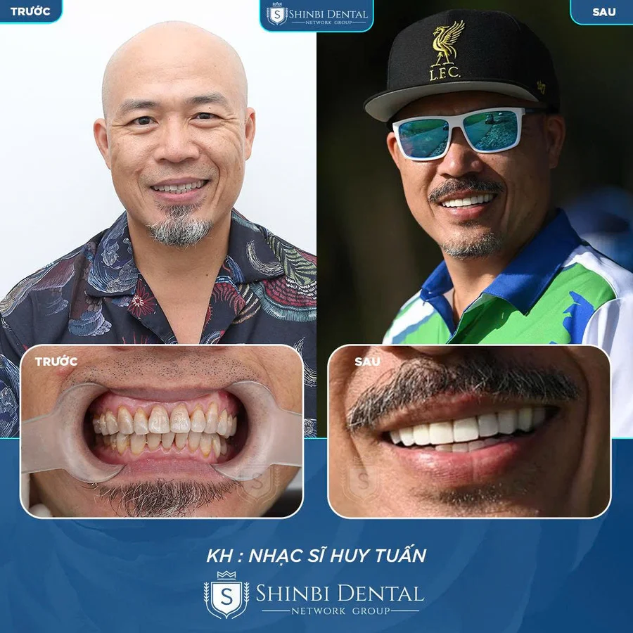 Răng sứ có bền không? Tuổi thọ thực tế bao nhiêu năm?