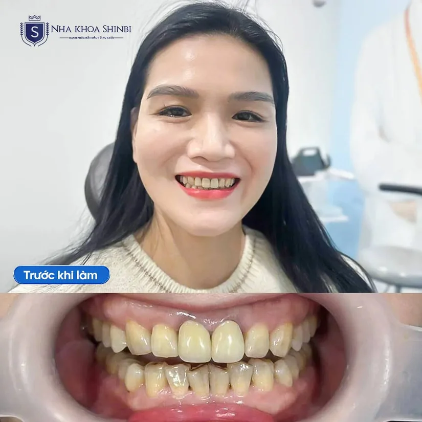 Răng sứ thẩm mỹ cao cấp – Đẹp tự nhiên, ăn Tết trọn vẹn