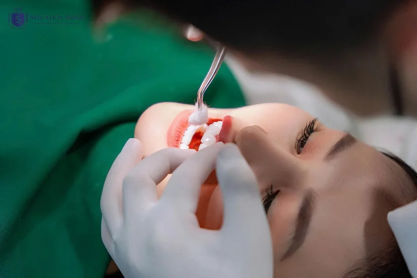 Răng sứ thẩm mỹ cao cấp – Đẹp tự nhiên, ăn Tết trọn vẹn