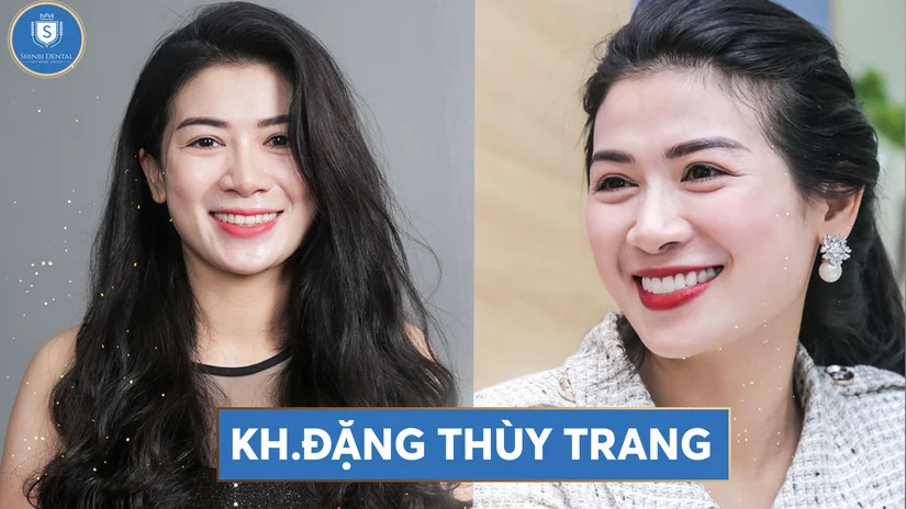 Răng sứ thẩm mỹ cao cấp – Đẹp tự nhiên, ăn Tết trọn vẹn