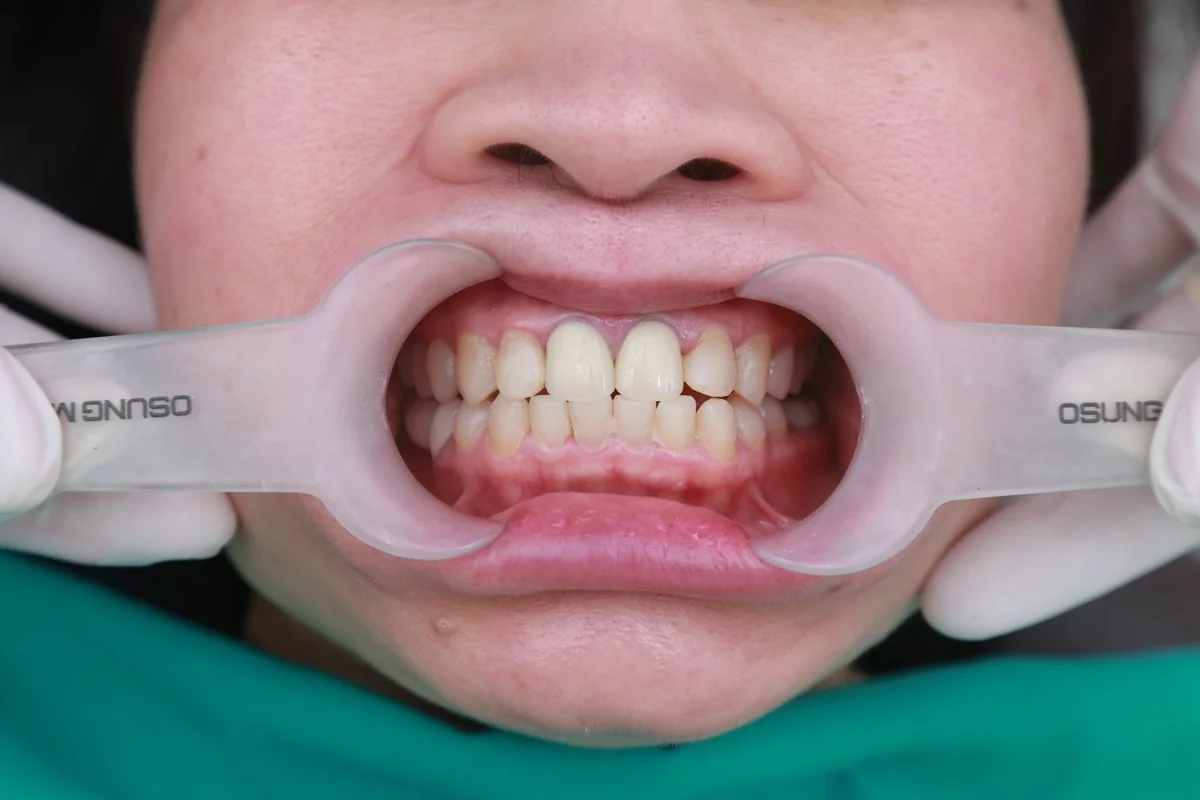 So sánh Niềng răng và Bọc sứ: chọn giải pháp nào tốt hơn