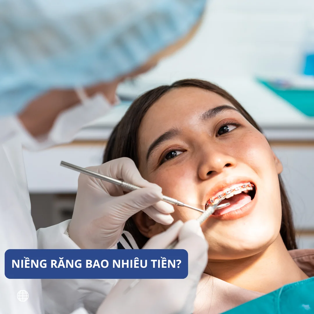 Bảng giá niềng răng chi tiết: trọn gói hay tính theo giai đoạn