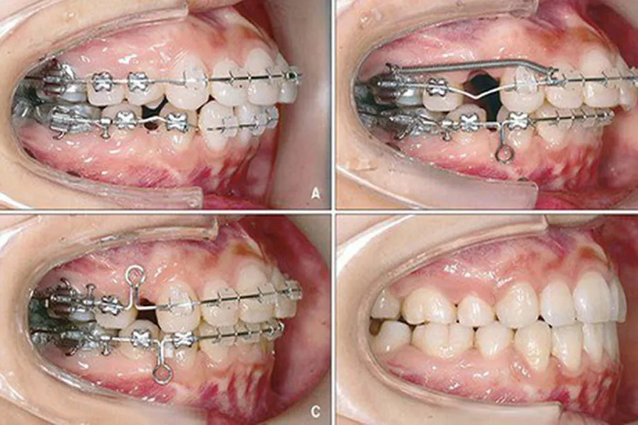 Bảng giá niềng răng chi tiết: trọn gói hay tính theo giai đoạn