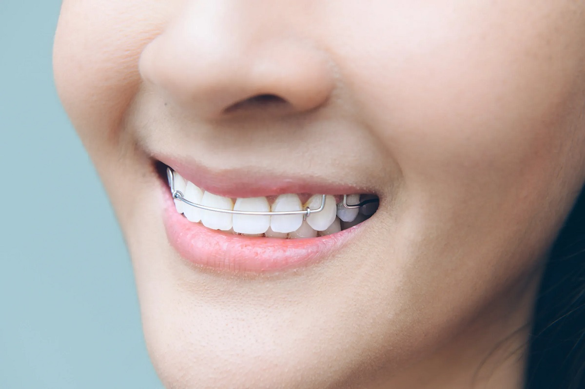 Bảng giá niềng răng chi tiết: trọn gói hay tính theo giai đoạn