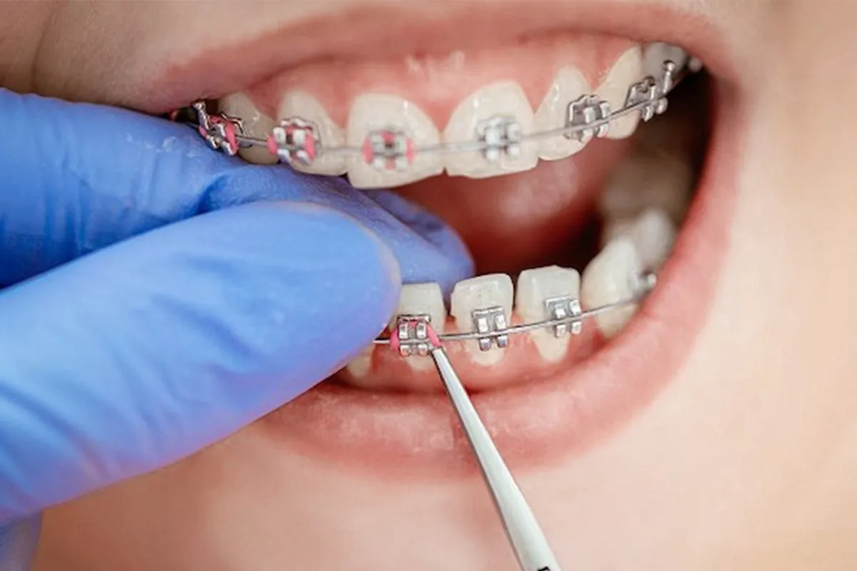 Bảng giá niềng răng chi tiết: trọn gói hay tính theo giai đoạn