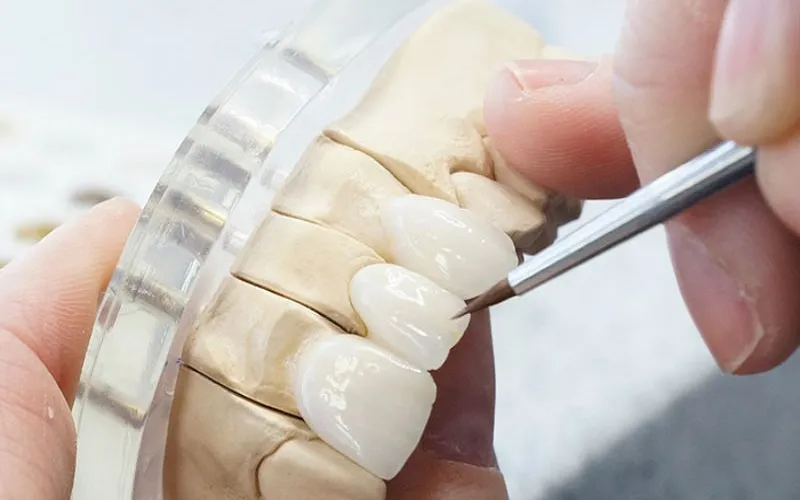 Địa chỉ bọc răng sứ Orodent chính hãng tại Trần Quốc Toản
