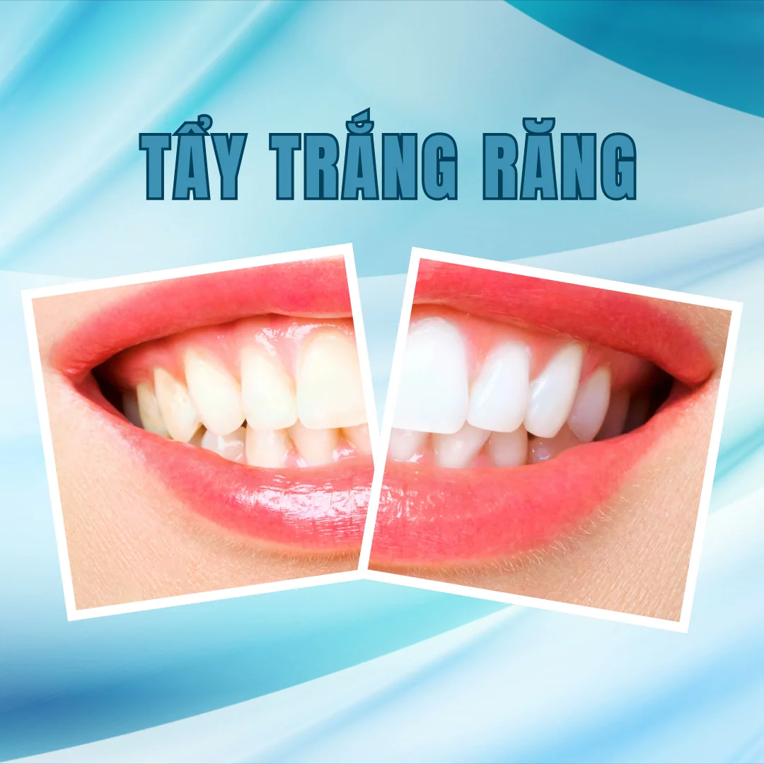 Địa chỉ tẩy trắng răng giờ nghỉ trưa cho dân văn phòng Trần Hưng Đạo