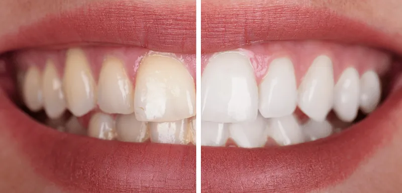 Địa chỉ tẩy trắng răng giờ nghỉ trưa cho dân văn phòng Trần Hưng Đạo
