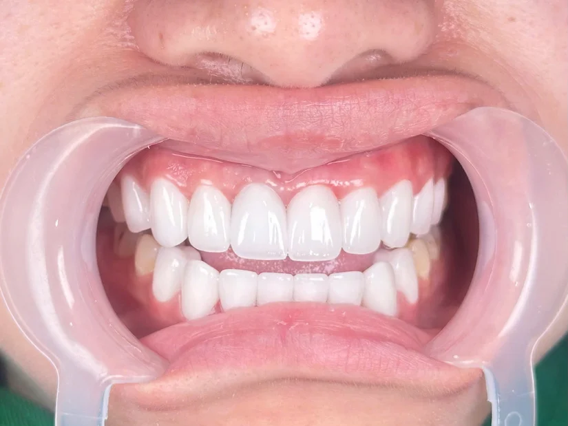 Có nên làm răng sứ trả góp? Giải pháp tài chính thông minh cho người bận rộn
