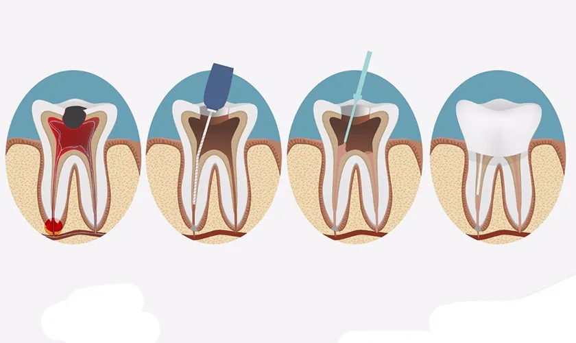 Điều trị tủy răng (nội nha) là gì? Quy trình chuẩn tại Shinbi Dental