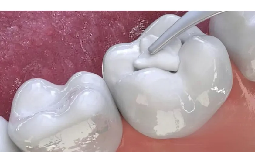 Điều trị tủy răng (nội nha) là gì? Quy trình chuẩn tại Shinbi Dental